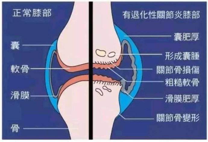 类风湿关节炎(ra)是一种病因未明的慢性,以炎性滑膜炎为主的系统性