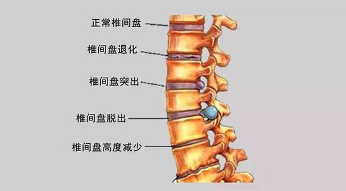 腰椎x线平片:单纯x线平片不能直接反应是否存在椎间盘突出,但x线片上